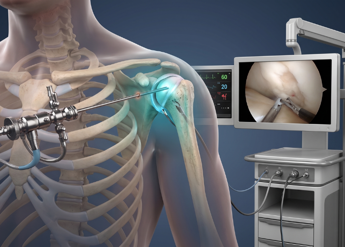 Is Shoulder Arthroscopy Safer Than Open Surgery?