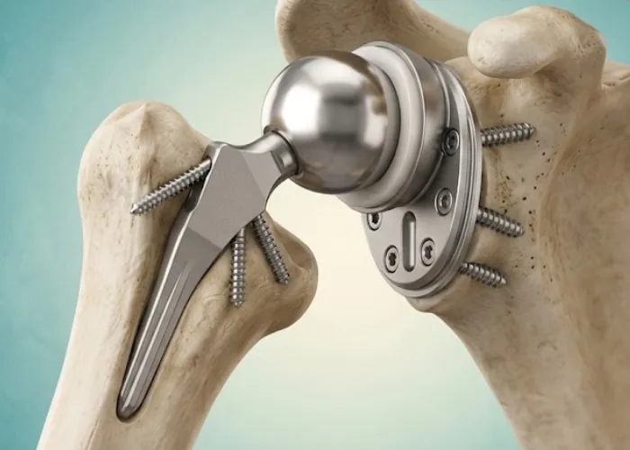 Type and Quality of Implant