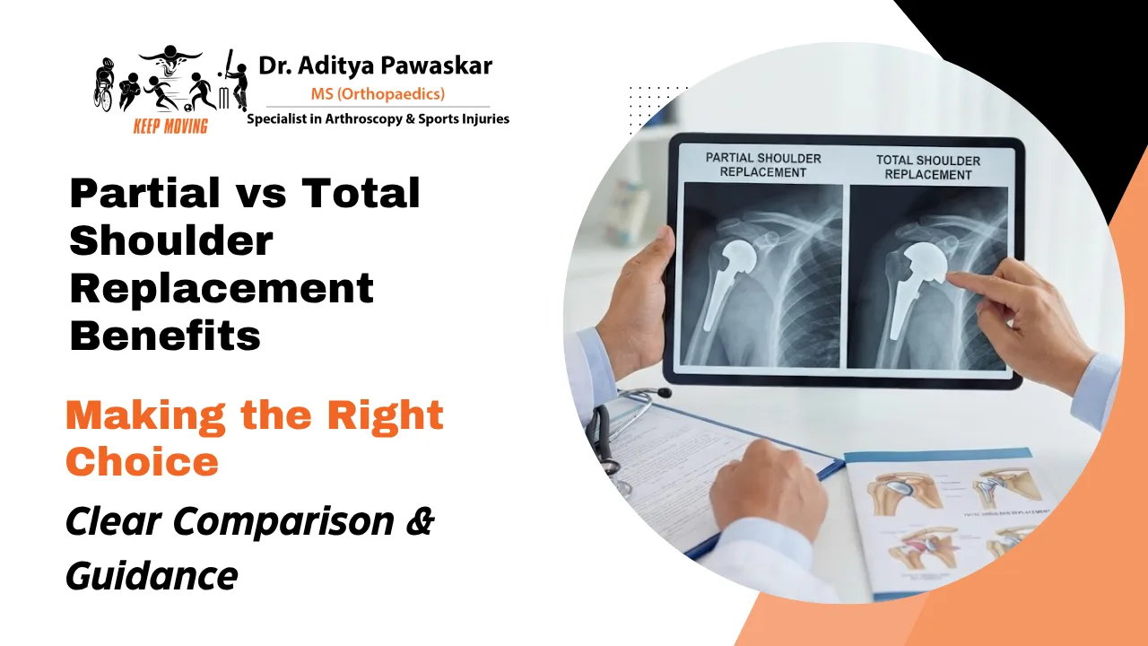 Partial vs Total Shoulder Replacement Benefits: Which Option Is Better?