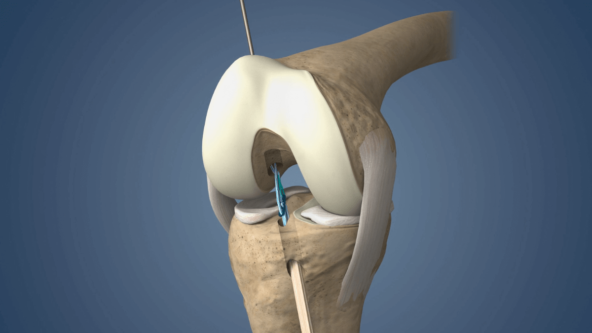 Internal Bracing for ACL Tear by Dr. Aditya Pawaskar, Specialist in Arthroscopy and Sports Injuries in Mumbai, Maharshtra in Matunga and Tardeo Road.