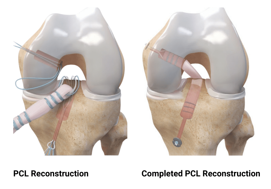 PCL Reconstruction by Dr. Aditya Pawaskar, Specialist in Arthroscopy and Sports Injuries in Mumbai, Maharshtra in Matunga and Tardeo Road.