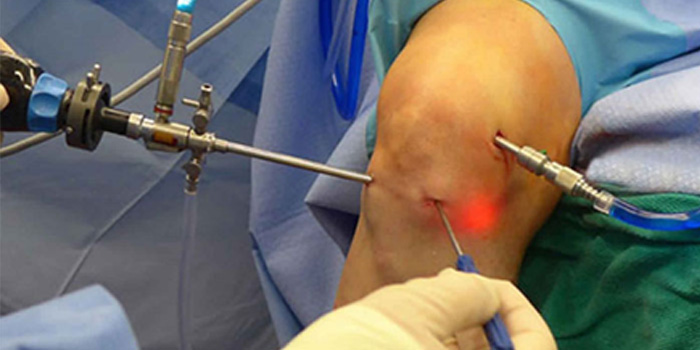 MCL Injury: Medial Collateral Ligament (MCL) Tear & Reconstruction, Knee  Surgeon in Mumbai