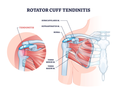 Rotator Cuff Tendonitis, Tear and Repair by Dr. Aditya Pawaskar, Specialist in Arthroscopy and Sports Injuries in Mumbai, Maharshtra in Matunga and Tardeo Road.